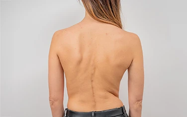 Degenerative Scoliosis